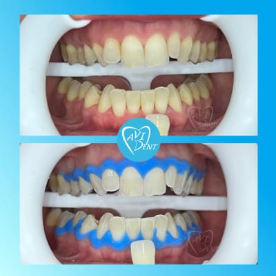 Професионално кабинетно избелване на зъби