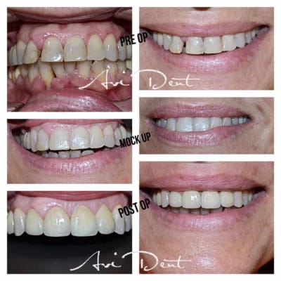 Възстановяване на усмивка с 4 броя единични керамични корони.