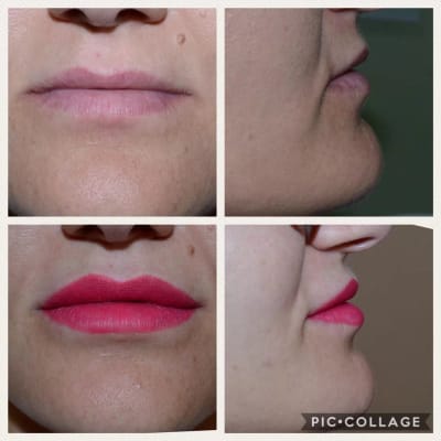 Обем на горна и долна устна с лек контур: JUVÉDERM®