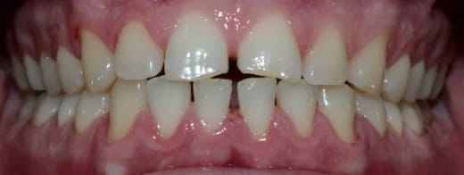 Зъби след почистване