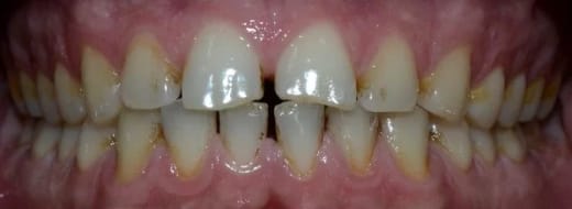 Зъби преди почистване