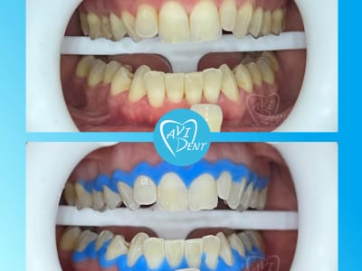 Избелване на зъби