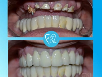 Имплантология и протезиране