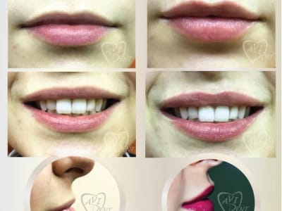  Обем на устни