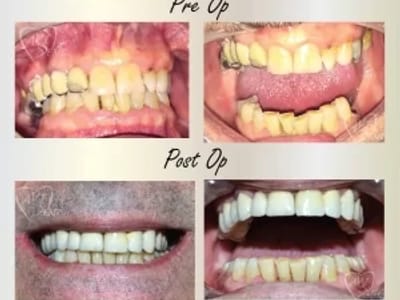 Пълна рехабилитация на челюсти