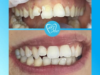  Подмяна на стари обтурации и пломби