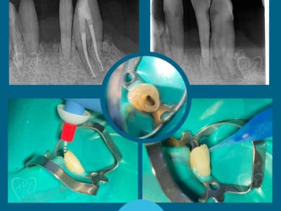  Ендодонтско лечение