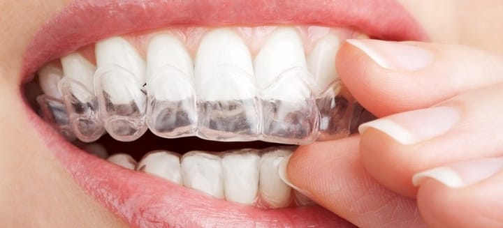 Снимка на прозрачна шина за избелване на зъби 