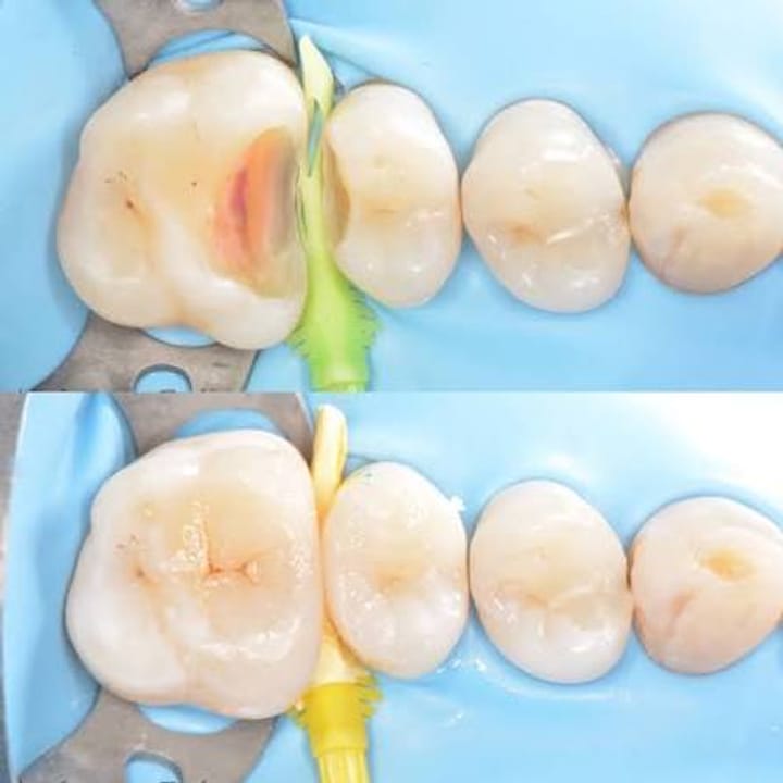 процедура при обтурацията