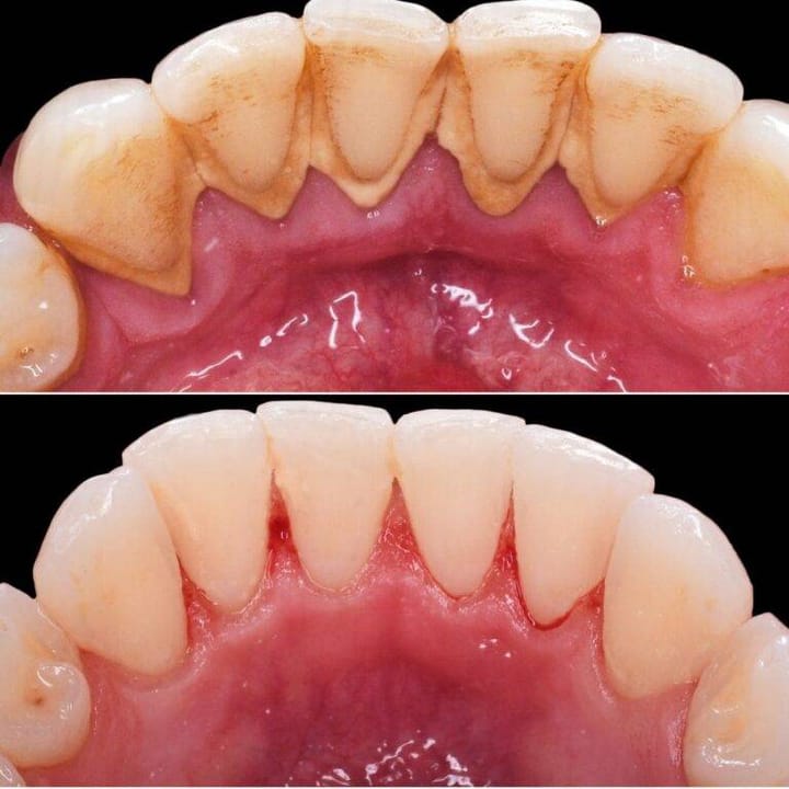 Преди и след почистване на зъбен камък