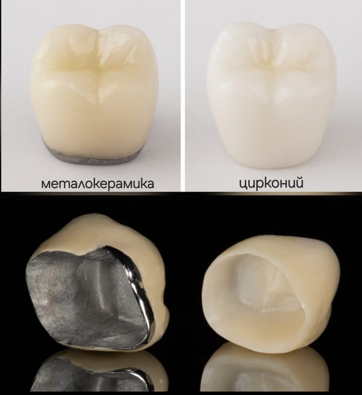 Циркониеви и метало-керамични коронки