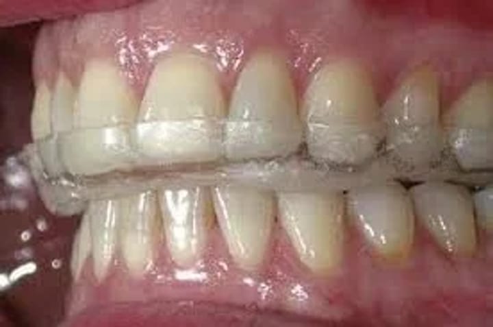 Шината за бруксизъм