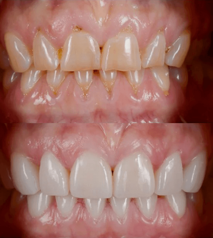 Снимка на преди и след керамични фасети