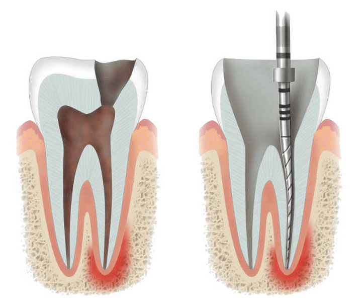 Кореново лечение