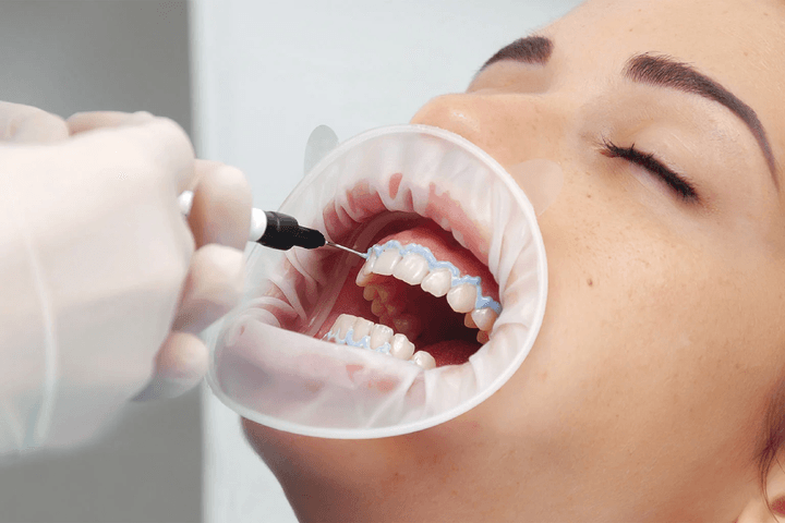 Стоматологична UV лампа при избелване