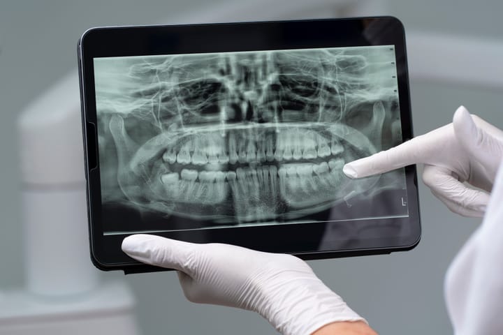 xray tooth
