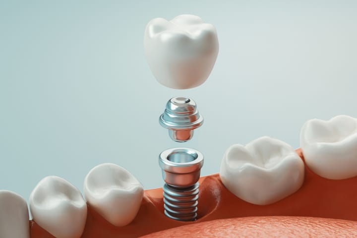 implant