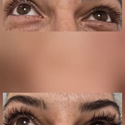 иглопластика