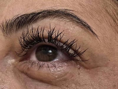 Миглопластика