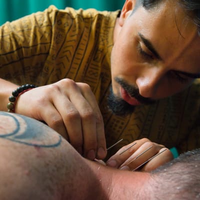 Акупунктура