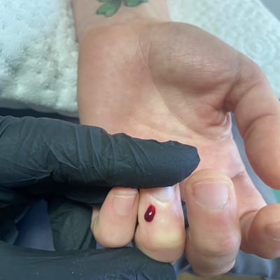 Кръвопускане