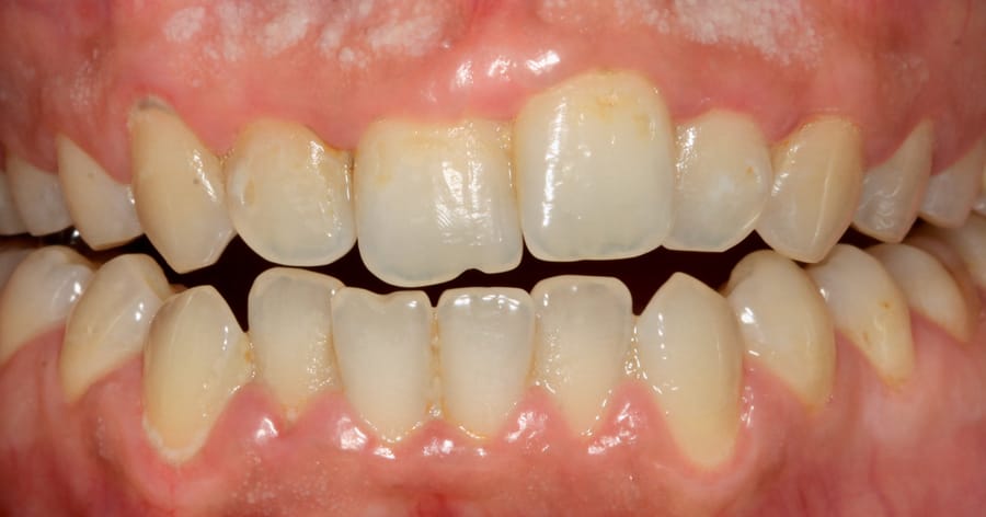 Гингивит: нормално състояние или проблем, който не бива да игнорирате!