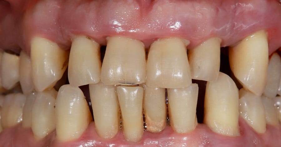 Пародонтит: Когато проблемът вече е по-дълбоко и костта се руши