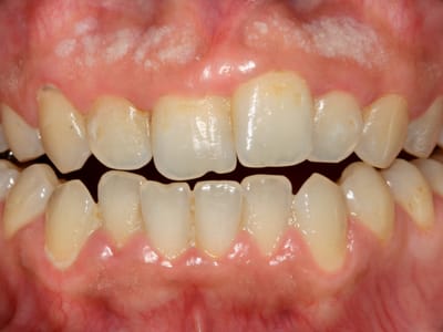 Гингивит: нормално състояние или проблем, който не бива да игнорирате!