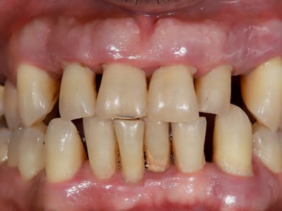 Пародонтит: Когато проблемът вече е по-дълбоко и костта се руши