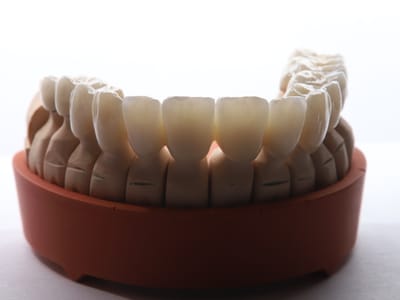 Циркониева или металокерамична коронка – какво да избера?