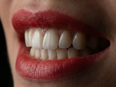 Фасети или коронки – как да изберете правилното решение за вашата усмивка